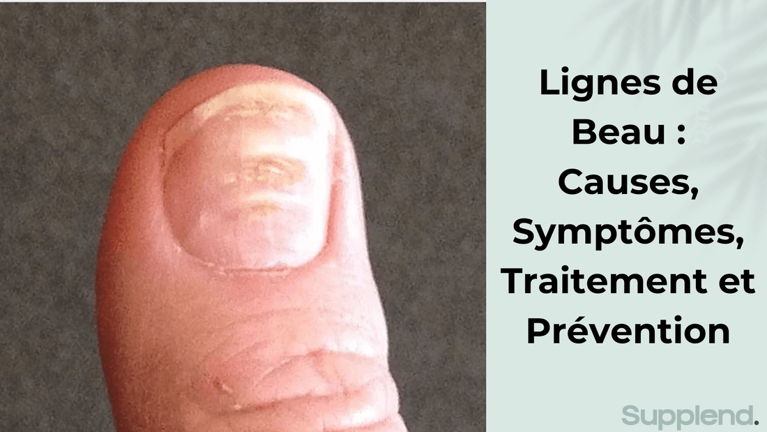 Lignes de Beau : Causes, Symptômes, Traitement et Prévention